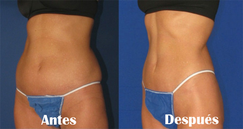 Radiofrecuencia corporal antes y despues de adelgazar
