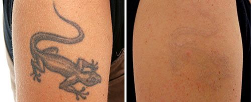 Cuanto cuesta quitar tatuajes con laser en mexico