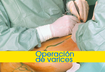 operacion-de-varices-3