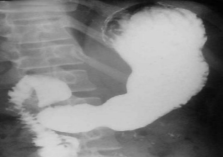 radiografia contrastada del estomago